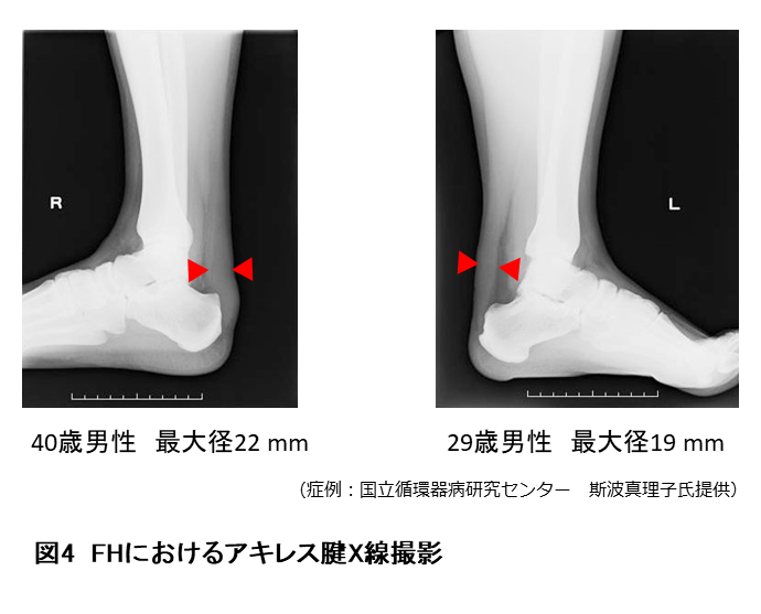 ホモ接合性家族性高コレステロール血症患者の今後の見通しはどうなりますか?